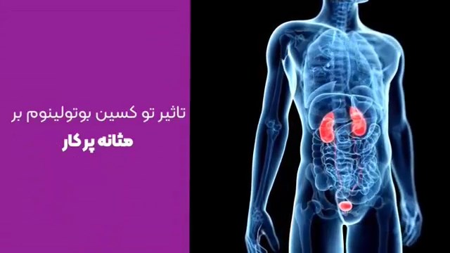 کاربرد توکسین بوتولینوم در درمان پرکاری مثانه