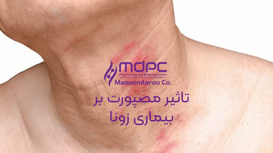 تاثیر-مصپورت-بر-زونا