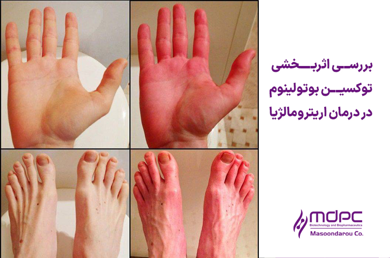 اثربخشی توکسین بوتولینوم در اریترومالژیا