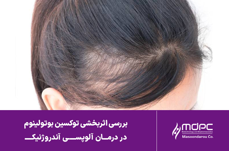 بررسی اثربخشی توکسین بوتولینوم نوع A در درمان آلوپسی آندروژنیک