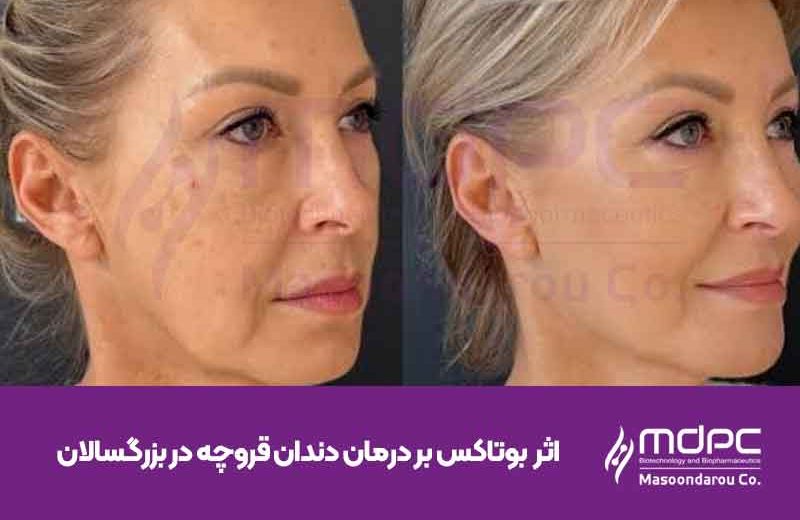 اثر-بوتاکس-بر-درمان-دندان‌-قروچه-در-بزرگسالان-2.jpg
