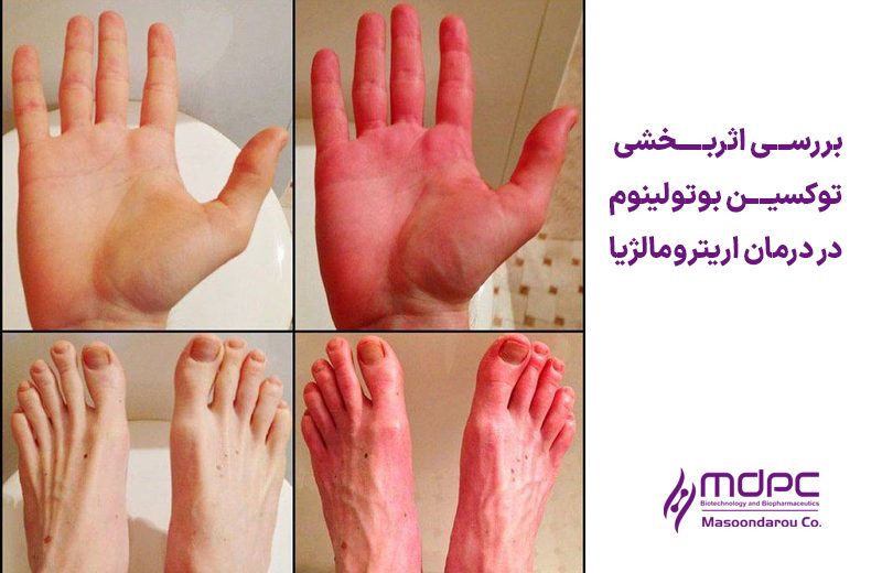 اثربخشی توکسین بوتولینوم در اریترومالژیا