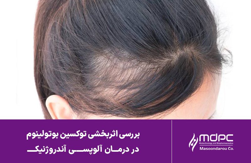 بررسی اثربخشی توکسین بوتولینوم نوع A در درمان آلوپسی آندروژنیک