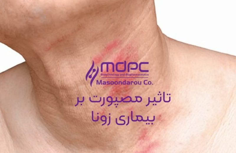 تاثیر-مصپورت-بر-زونا