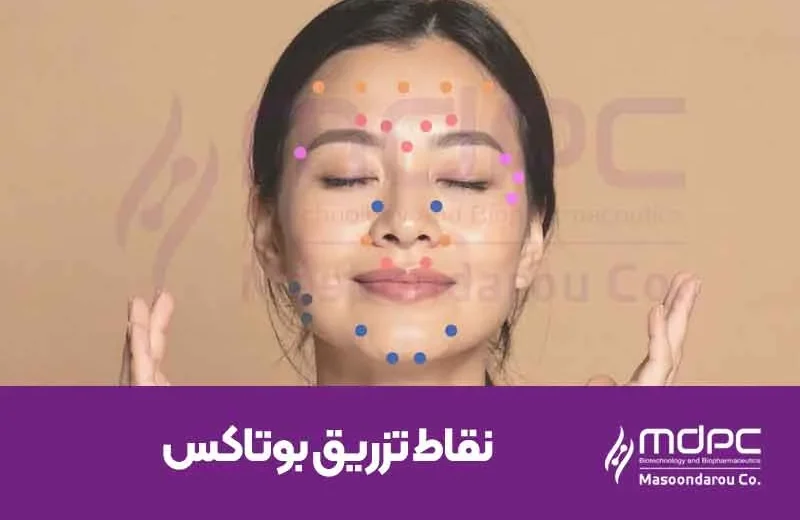 نقاط-تزریق-بوتاکس.webp