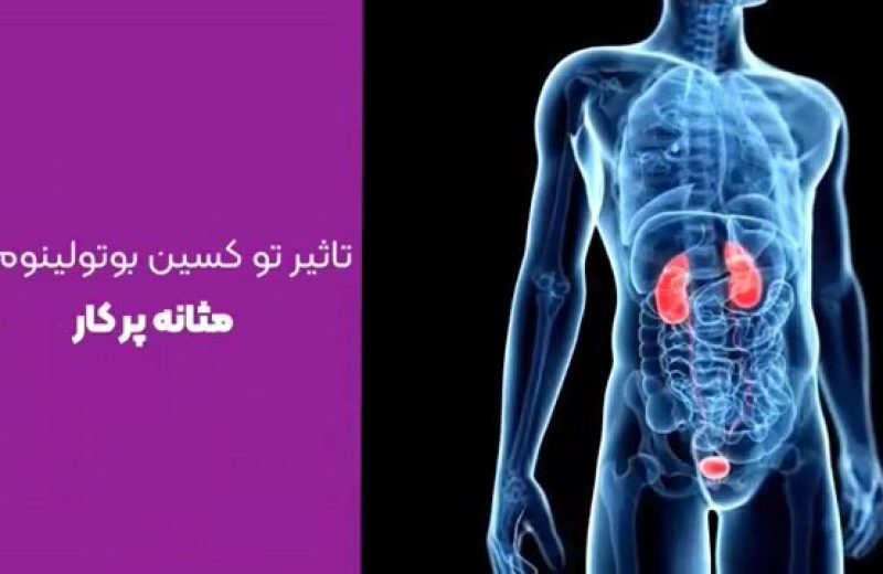 کاربرد توکسین بوتولینوم در درمان پرکاری مثانه